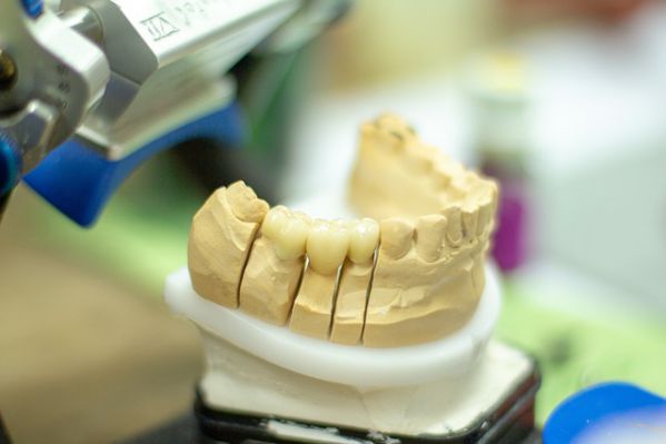 Beste Zahnbehandlungen dank einer Zahnzusatzversicherung